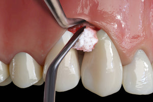 Hu-Friedy PM Split Periosteal, Short, Black Line | SurgiMac Dental Supply