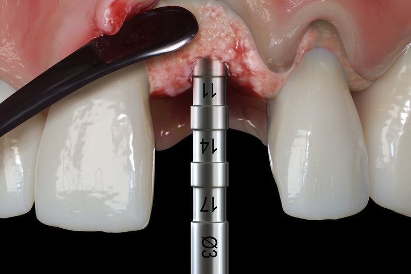 Hu-Friedy PM Split Periosteal, Short, Black Line | SurgiMac Dental Supply