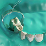 Hu-Friedy Upper Left Primary 2nd #6 Refill | SurgiMac Dental Supply