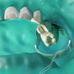 Hu-Friedy Upper Right Primary 2nd #7 Refill | SurgiMac Dental Supply
