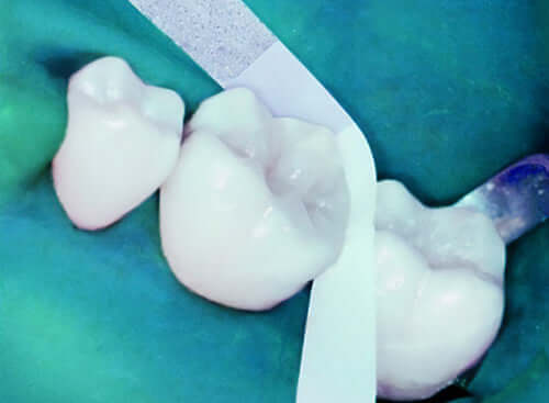 SeptoFipo Interproximal Strips, 2.5mm x 7