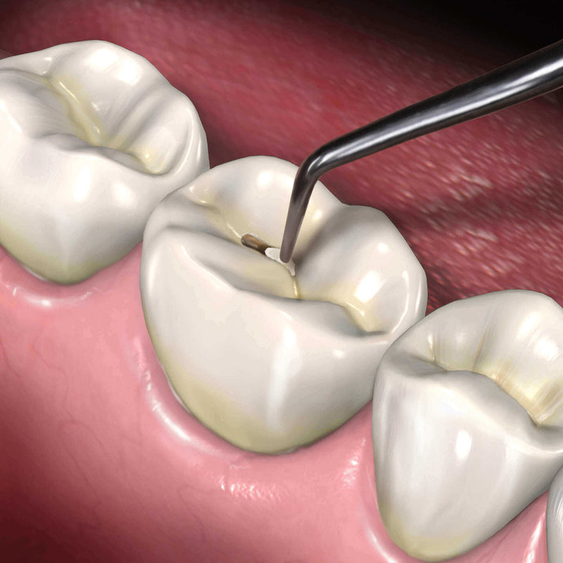 Hu-Friedy Micro Mini 1 Goldstein Flexi-Thin XTS™ Composite Instrument | SurgiMac Dental Supply