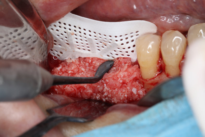 Hu-Friedy Urban Mini Me Micro Periosteal, Black Line | SurgiMac Dental Supply