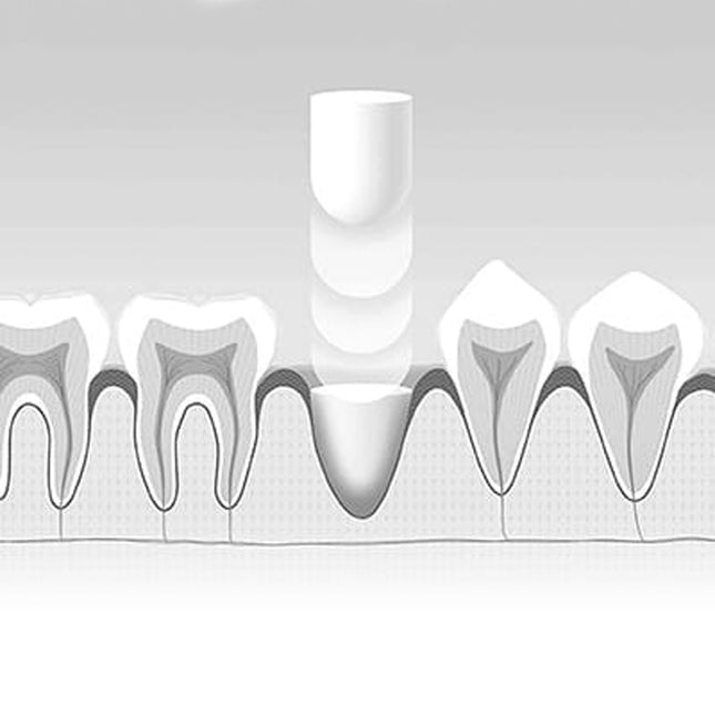 J. Morita | Bone Filling Augmentation Material - Small 8mm x 25mm | 27500100