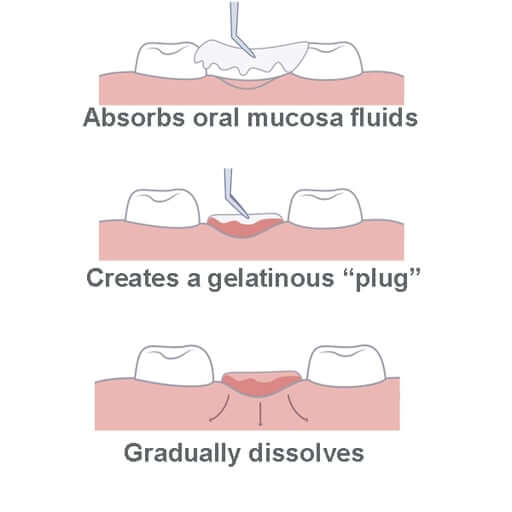 HemoStat SafeGauze Topical Hemostatic Dressing is a sterile, woven, pH neutral 4900-STAT