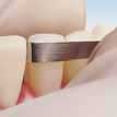 Premier Compo-Strip 200T2 - For Orthodontic Reproximation, flexible