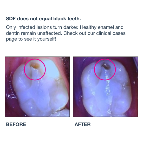 Centrix SilverSense SDF - 38% Silver Diamine Fluoride