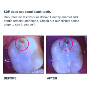 Centrix SilverSense SDF - 38% Silver Diamine Fluoride