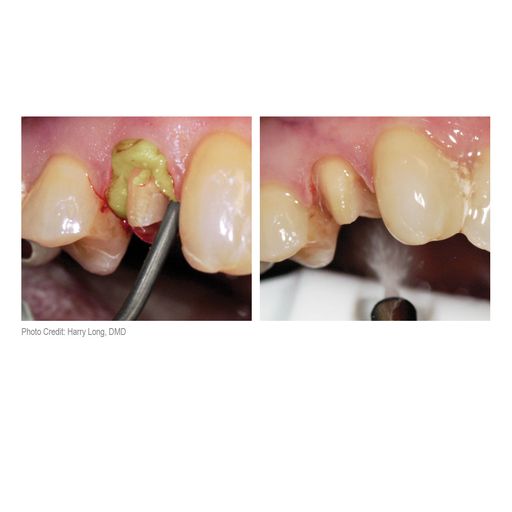 Dryz Retraction Paste - Syringes Green (7pcs) S180