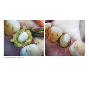 Dryz Retraction Paste - Syringes Green (7pcs) S180