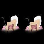 Hu-Friedy Goldstein Micro Placement Instrument | SurgiMac Dental Supply