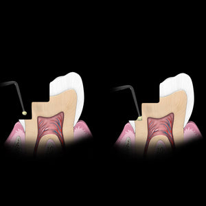 Hu-Friedy Goldstein Micro Placement Instrument | SurgiMac Dental Supply