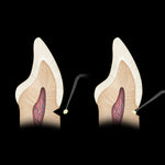 Hu-Friedy Goldstein Micro Placement Instrument | SurgiMac Dental Supply