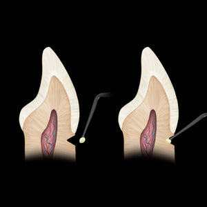 Hu-Friedy Goldstein Micro Placement Instrument | SurgiMac Dental Supply