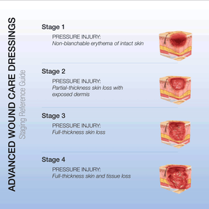 Dynarex CuraFoam Foam Dressings 3011